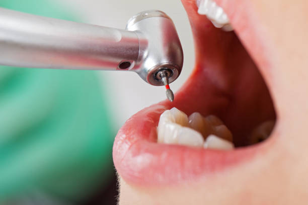 Best Dental Abscess Treatment in Kingsburg, CA